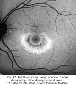 Fig-47DonPlaquenil
